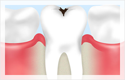 一般歯科（虫歯治療）