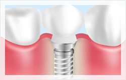 インプラント
